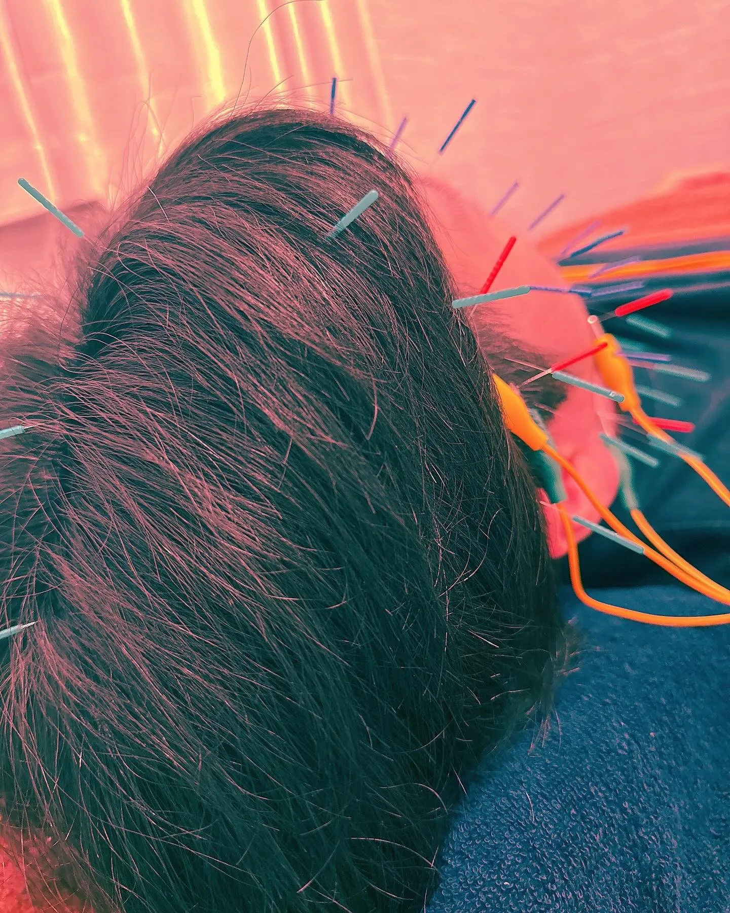 美容鍼56本通電10分