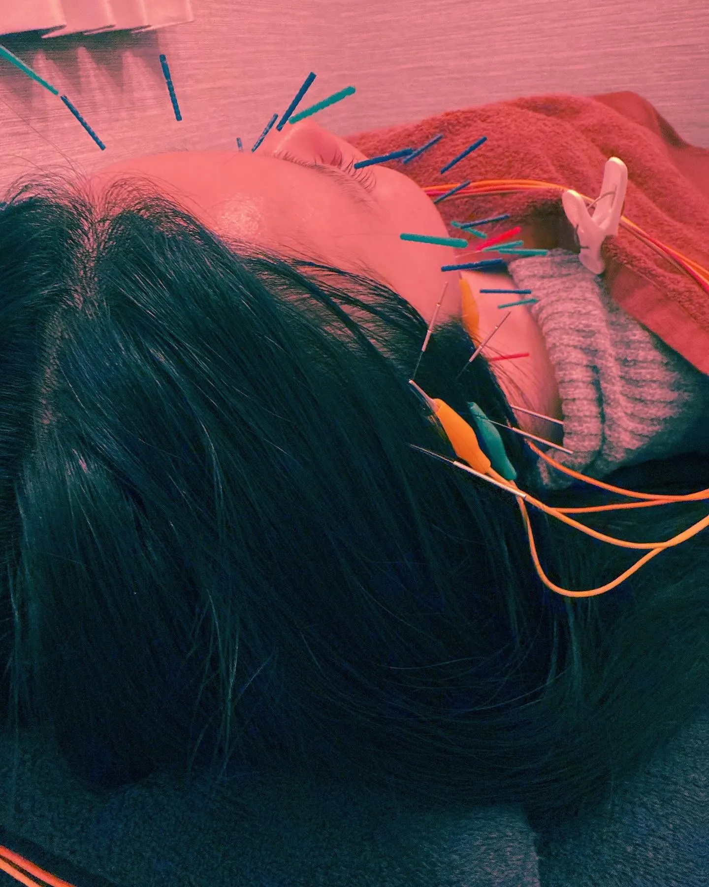 美容鍼51本　頬、側頭筋通電10分🐈‍⬛✨