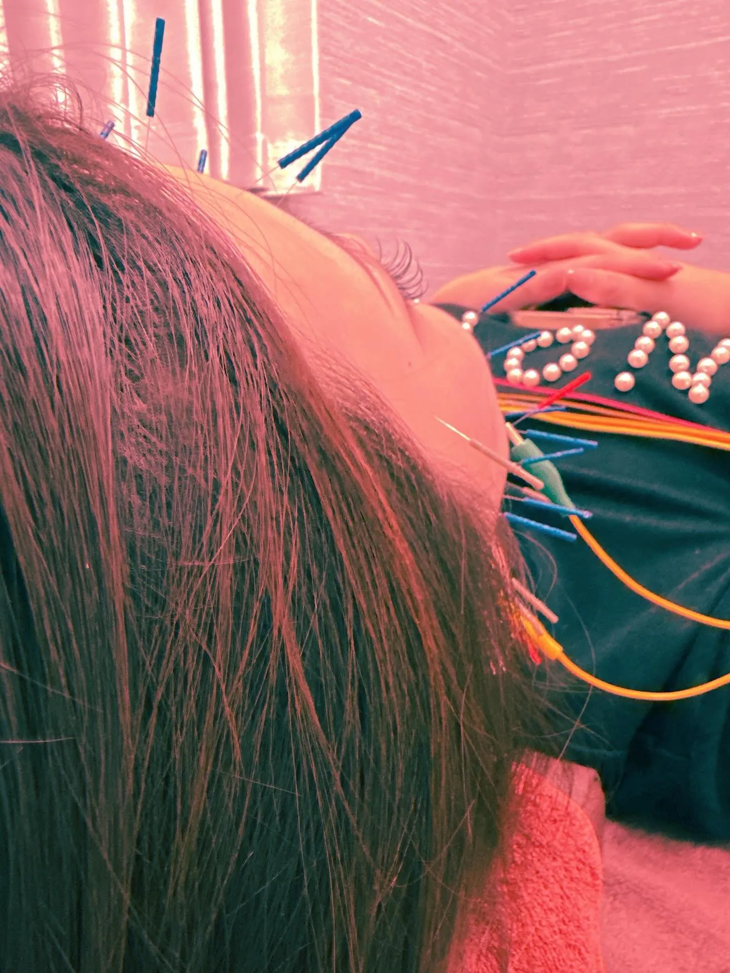 美容鍼51本通電10分　むくみ改善/小顔改善🐈‍⬛✨