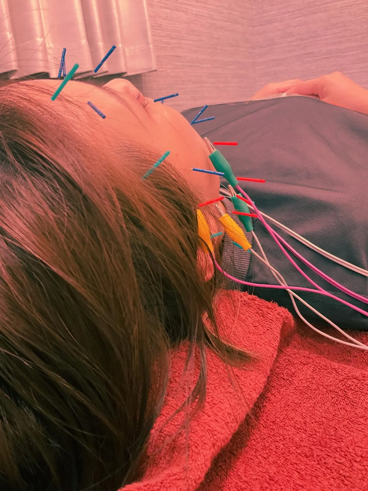 美容鍼46本🌟お久しぶりです🐈‍⬛