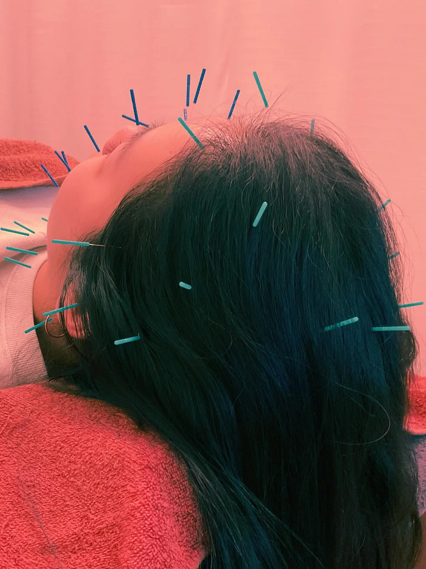 初めての美容鍼🌸