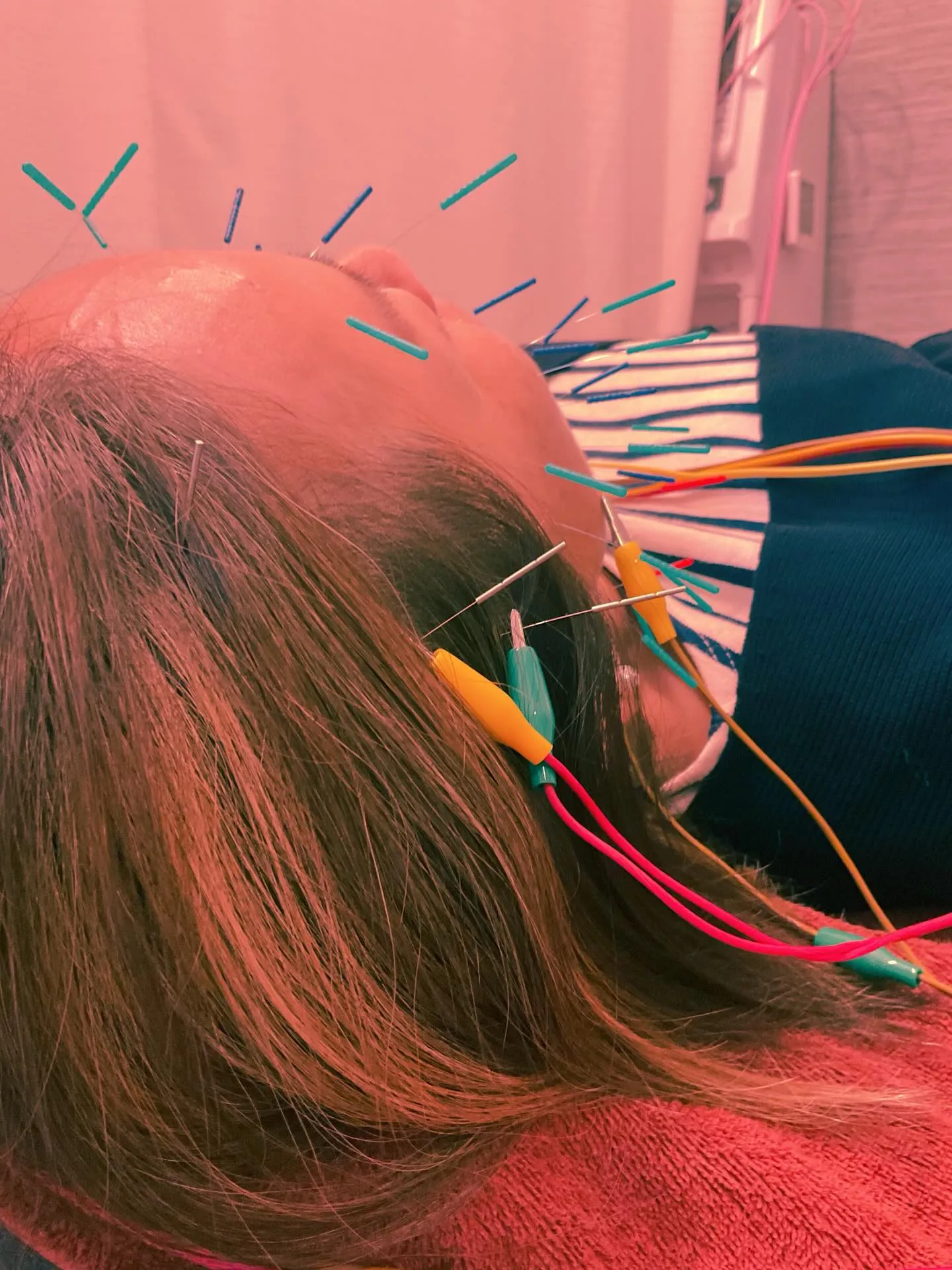 美容鍼パルスあり❤️